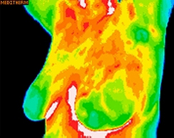 Thermography image of breast